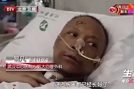 武汉两医生被ECMO救回后脸色发黑，专家解释原因图片
