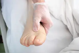 孕期水肿症状有哪些？产后水肿应该怎么解决图片