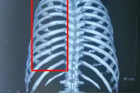 摔一跤，折7根肋骨，医生凭什么让患者回家了？真的不需要治疗吗图片