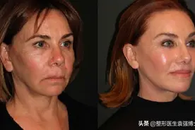 给40-50岁面部松垂者，一些真实有用的抗衰建议图片