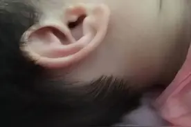 副耳是需要进行整形手术治疗的一种疾病图片