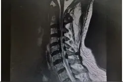 【医者解读】颈源性头痛您了解吗？图片