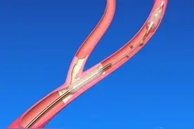 健康科普堂 | 冬季说说颅内动脉瘤的介入栓塞治疗图片