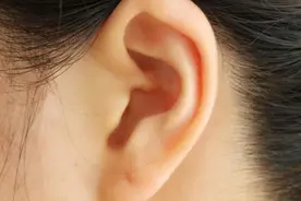 为什么有些人一生下来，耳朵边上就有个小孔？图片