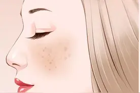难治的黄褐斑，我该拿你怎么办？图片