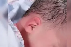 宝妈分娩时不懂如何用力，宝宝头部被挤压变形，网友：像寿星公图片