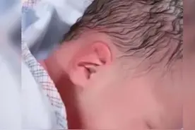 宝妈分娩时不懂如何用力，宝宝头部被挤压变形，网友：像寿星公图片