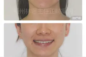 福州牙齿矫正｜牙齿拥挤怎么矫正好？图片