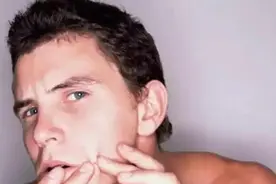 男生长痘痘科普及攻略图片