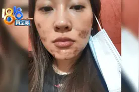 痘印处加强处理，几天后结痂掉皮图片