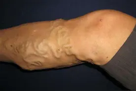 一个小动作改善“蚯蚓腿”图片