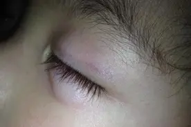 女孩错把502胶水当成眼药水，滴进了眼里，医生夸赞奶奶做法到位图片