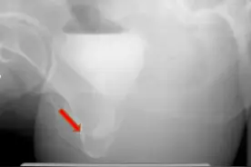 广场舞跟不上节奏，咳嗽、大笑就会“尿裤子”，56岁杭州女子苦不堪言！专家：可治愈，别耽误图片