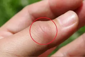 睡觉时有3种表现，是高尿酸发出的“提醒”，3类人要重视图片