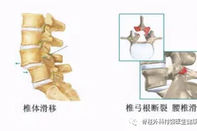 名医专访丨上海交通大学附属第一人民医院付强：腰椎滑脱那些事儿图片