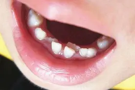 宝宝旧牙整齐，换完新牙却歪的一塌糊涂，很可能是这些事没做好图片