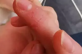 手上脱皮就是真菌感染吗？图片