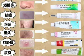祛痘印护肤干货，痘肌自备皮肤药膏合集图片