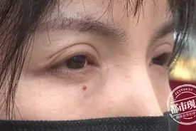 “想做宽一点！”女子花万元做整形，不料眼皮由双变成三层图片
