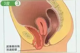 20%的产后妈妈都会出现阴道膨出、子宫脱垂的风险，还敢拖下去吗图片