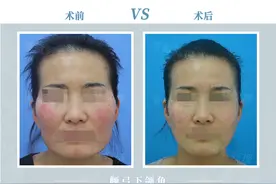颧弓下颌角术后的她，不仅变美更减龄图片