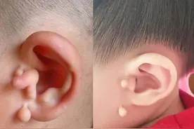 孩子耳朵前面的小肉球和小洞洞是啥？老人说是福气，可没那么简单图片