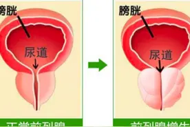 得了前列腺增生怎么办？前列腺增生能否治愈？医生一文为你说清楚图片