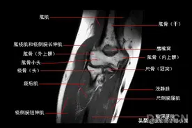 肘关节磁共振（MRI）解剖--精品图集图片