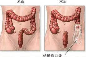 没有肛门了，造口很恐怖？大肠癌术后如何在家护理“肠造口”图片