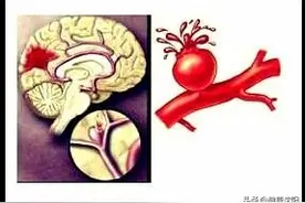 健康科普堂 | 牢记十个“必须”可以有效预防脑出血图片