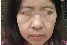 48岁做拉皮手术，聊聊我的经历图片
