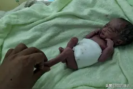 早产双胞胎出生时妹妹不足2斤，腿没爸爸手指粗，妈妈曾严重贫血图片