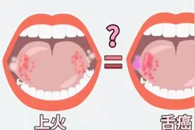 口腔溃疡可能导致严重后果，医生告诉你怎么分辨口腔溃疡与舌癌视频封面
