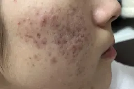 17岁女儿脸上长满痘痘，看了这篇文章才知道如何帮助她图片