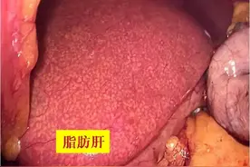 减重代谢手术可缓解脂肪肝吗？图片