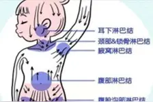 是癌不是癌？一颗淋巴结的自白图片