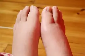 产后也水肿？树袋宝宝教你怎样做图片