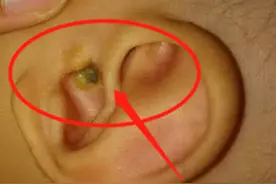 虫子爬进4岁儿子的耳朵，被妈妈的一个举动给拯救，连医生都称赞图片