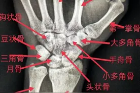 学习《X线读片指南》骨、关节系统——腕关节图片