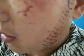 中学教师左眼被打失明，哥哥获刑一年缓刑两年，当事人指控实为嫂子抠的，但遭否认图片