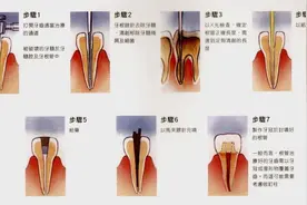 什么是根管治疗?图片