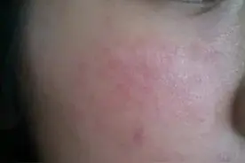 化妆品接触性皮炎护理指南图片