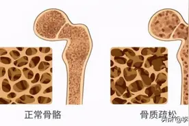 五十岁的女性，如何补钙对抗骨质疏松？这3个细节要注意图片