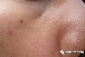 「库博士小讲堂」关于红肿大痘痘，我们该怎么处理？图片