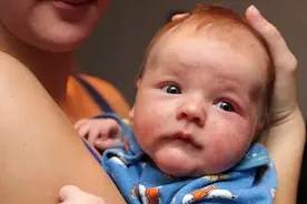 辟谣，宝宝湿疹就要断母乳？错，调节妈妈饮食才是关键图片