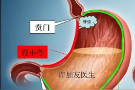 胃都切了，怎么吃饭？图片