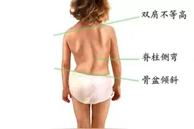 发现自己高低肩，你该怎么办？图片