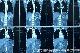 得了肠梗阻怕手术？一根管子就“搞定”图片