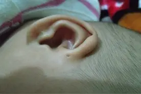 为什么个别新生儿的耳朵有“小孔”？医生很难告知，父母要明白图片
