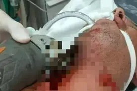 事故通报：某员工使用角磨机切割物件，不慎脱手弹飞直接切到脖子图片